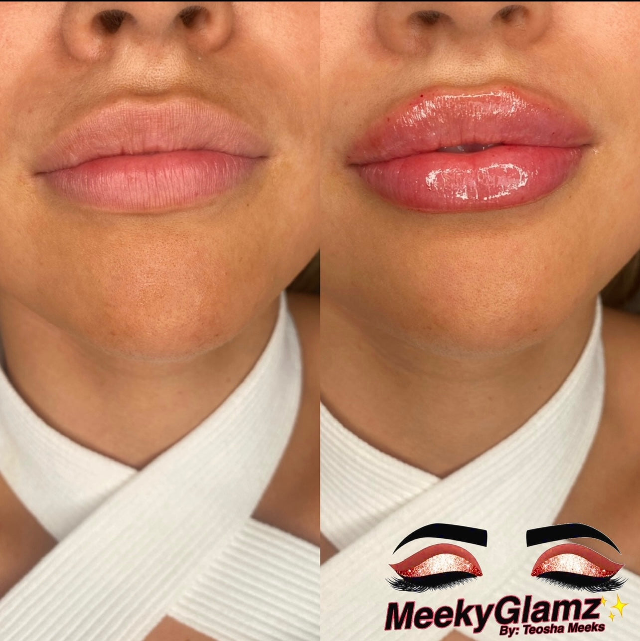 Hyaluronic Acid Lip Fillers